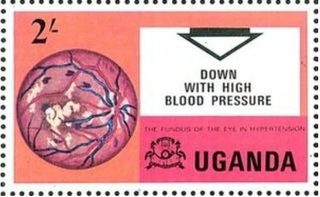 高血圧眼底.1978.ウガンダ.jpg